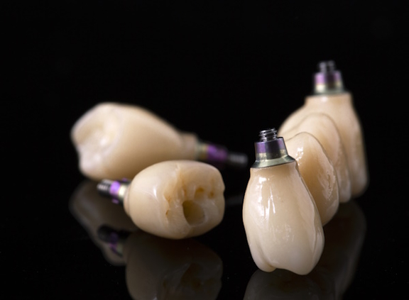 Behandlungsschwerpunkt Zahnimplantate, GoDent, Dr. Saina Zimmermann, Zahnärztin in Gommiswald